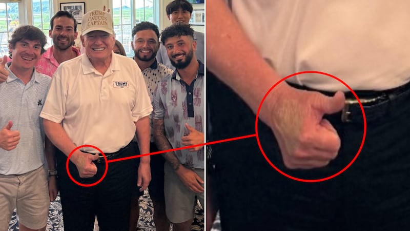 Trump hand shows discoloration in photos posted on X.