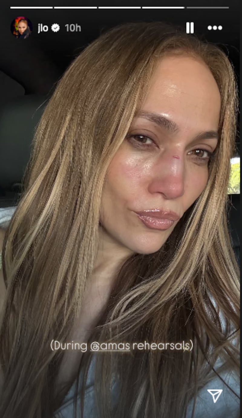 An Instagram photo of Jennifer Lopez with swelling on her mid-face and a cut on her nose.