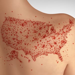 The US Measles Outbreak