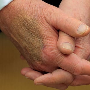 Makeup covers a bruise on the back of U.S. President Donald Trump's hand as he hosts French President Emmanuel Macron for meetings at the White House on February 24, 2025 in Washington, DC.