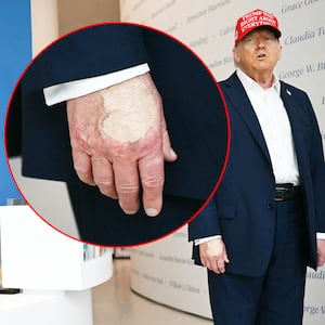 Make-up concealer on President Donald Trump's hand is seen as he speaks at "The People's House."