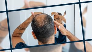 Happy Heads Hair Loss Treatment