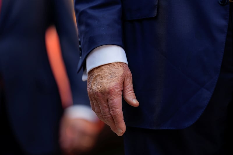 Make-up covers the back of the right hand of President Donald Trump.